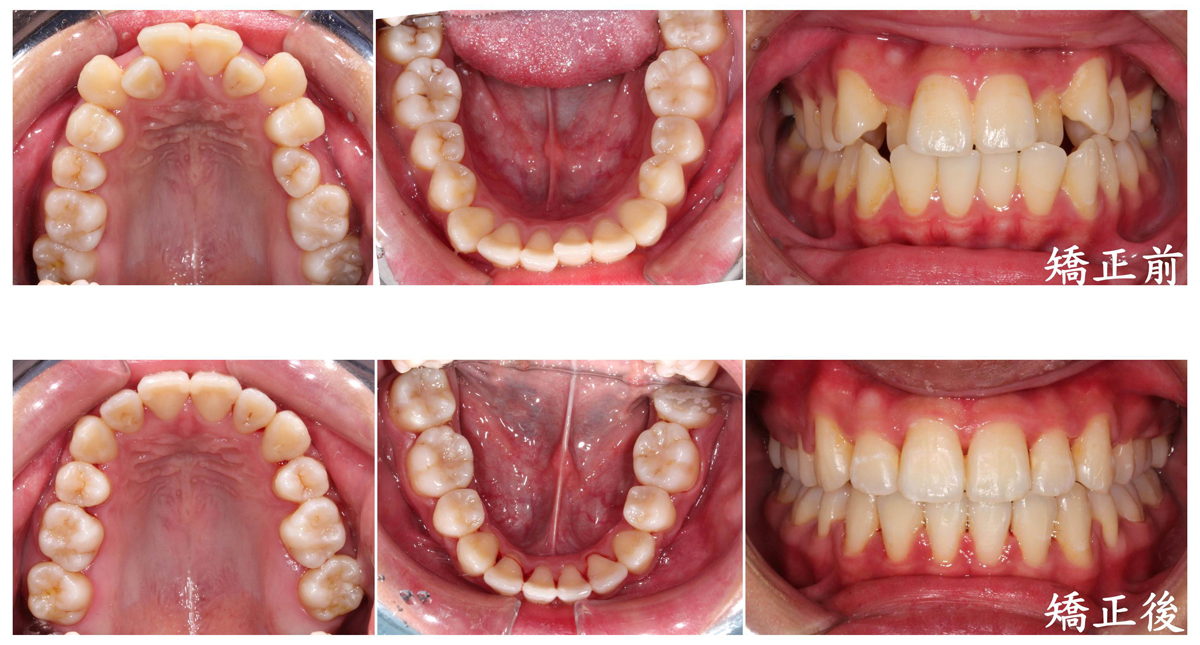 許嘉軒醫師矯正case解說03